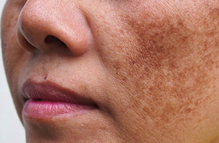 Nám là tình trạng trên da xuất hiện nhiều mảng sẫm màu