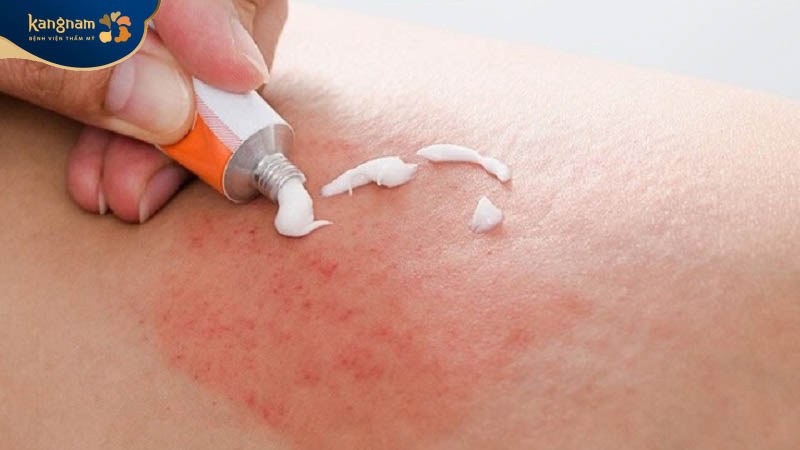 Vùng triệt lông có thể bị bỏng