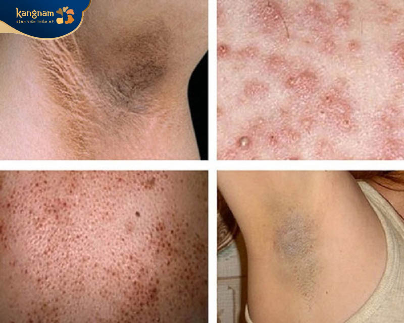 Tổn thương da, tăng sắc tố khi triệt lông không đúng cách