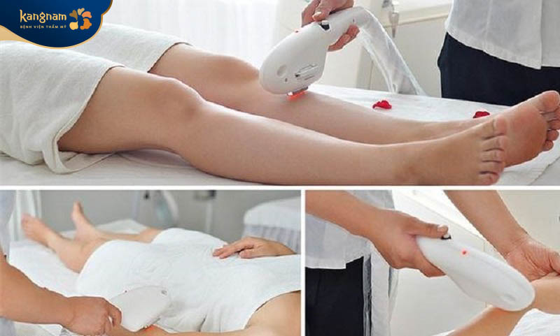 Chị em không nên quá lo lắng về tác hại của triệt lông vĩnh viễn