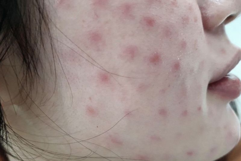 Tụ máu sau tiêm meso