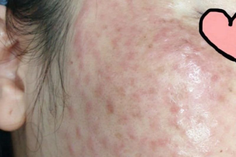 Da dị ứng, mẩn ngứa sau tiêm meso