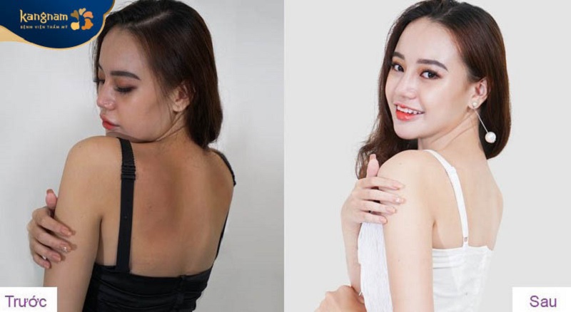 Làn da của khách hàng trắng sáng bật tone rõ rệt