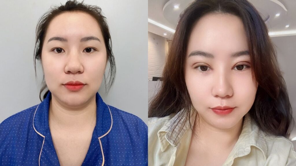 Hành trình khắc phục mắt mí lót của Thanh Hiền tại Kangnam Hà Nội