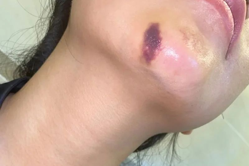 Vùng tiêm đau nhức, tím tái là biến chứng nặng