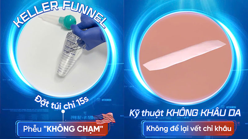 Thời gian thực hiện nhanh, không tiếp xúc trực tiếp với túi ngực