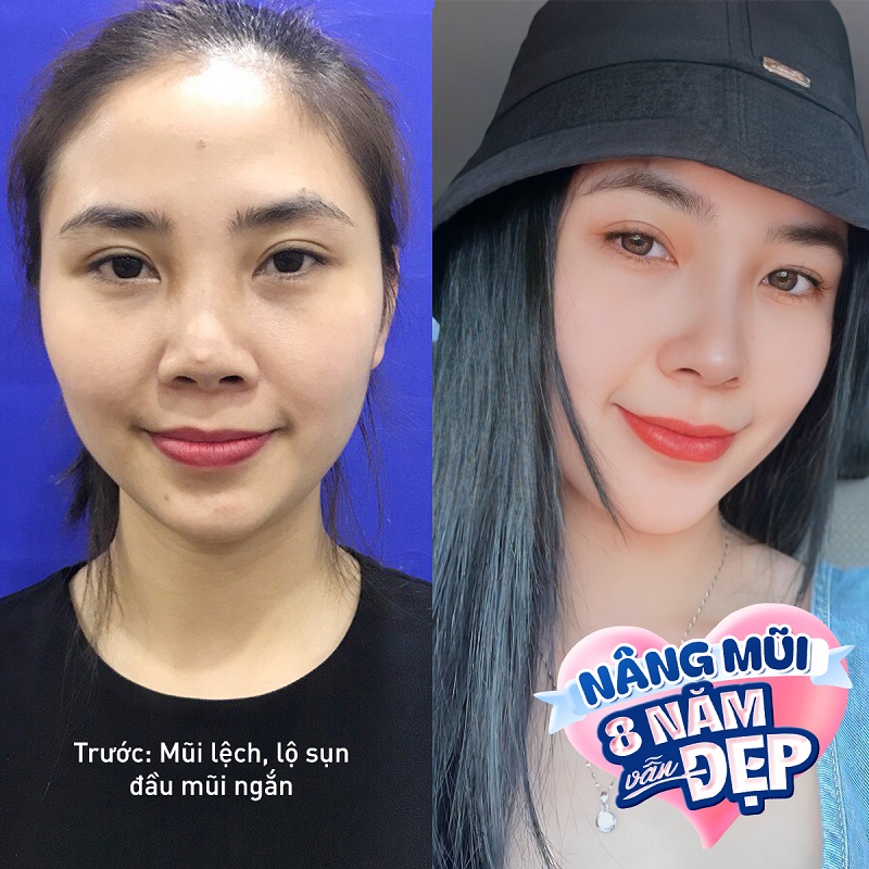 Hỗ trợ giảm giá chi phí sử mũi hỏng