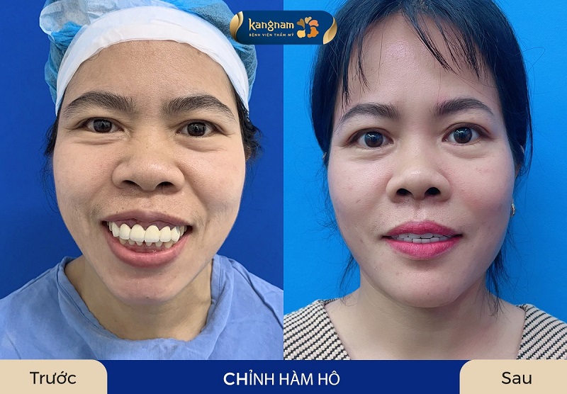 Chỉnh hình hàm mặt giúp khách hàng cải thiện được khuyết điểm hàm hô