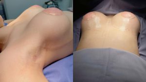 Chuyên gia giải đáp các thắc mắc về nâng ngực không chạm – không khâu da