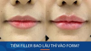 Tiêm filler bao lâu thì vào form? Những yếu tố ảnh hưởng