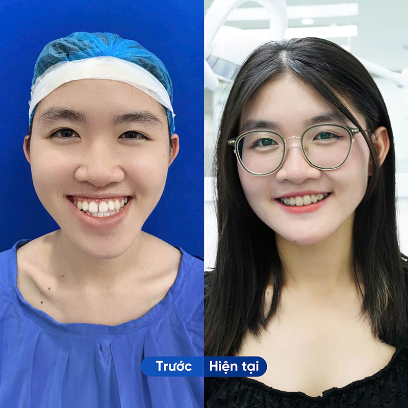 Kết quả phẫu thuật hàm mặt thường duy trì vĩnh viễn