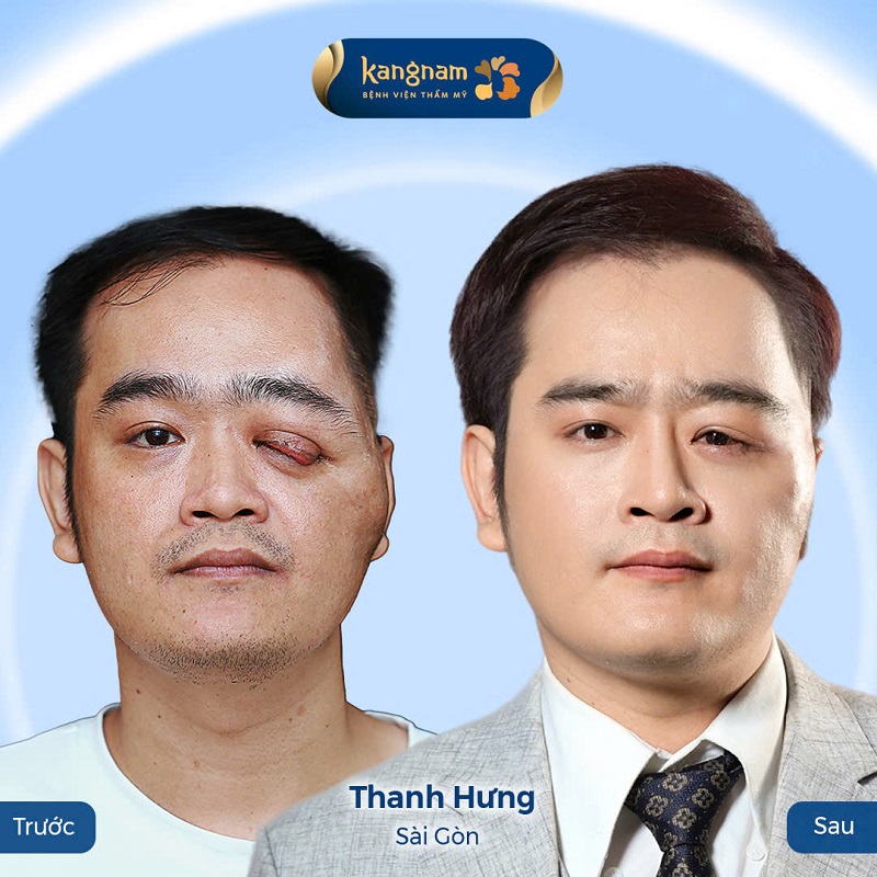 Thanh Hưng đã tự tin hơn với ngoại hình mới