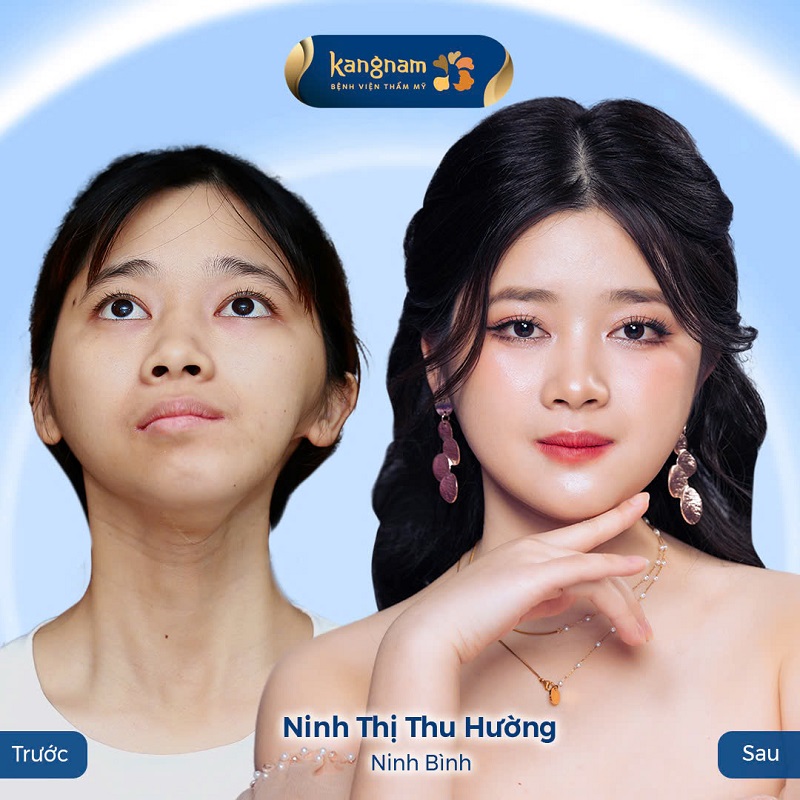 Ninh Thu Hường xinh đẹp và tự tin hơn sau khi phẫu thuật thay đổi ngoại hình