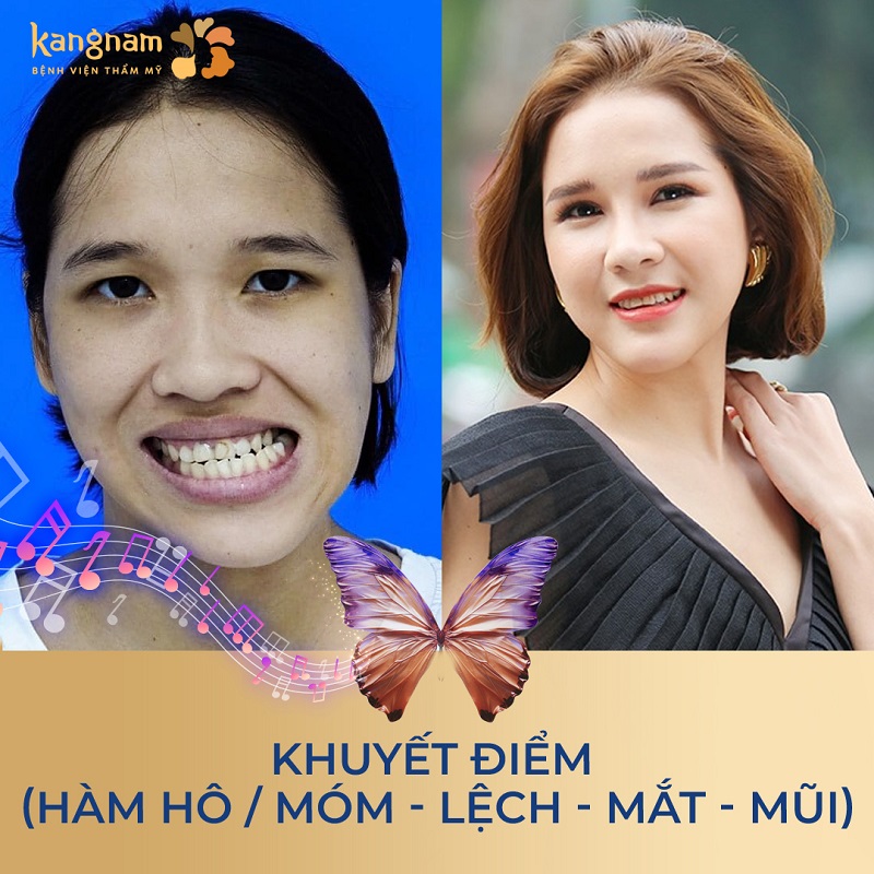 Thí sinh Thu Hiền được khắc phục tình trạng hàm lệch, móm