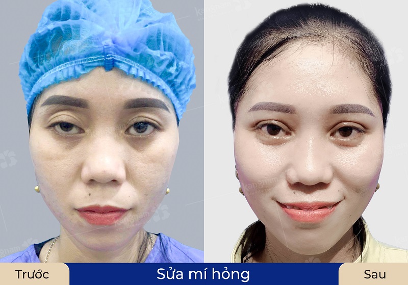 Mí mắt sau 6 tháng đã có thể chỉnh sửa được