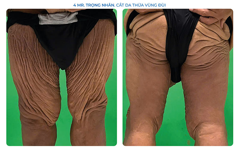 Da thừa vùng đùi sẽ được phẫu thuật trong lần thứ 4