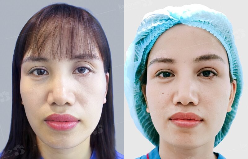 Hai mí không đều nhau, bên to bên nhỏ