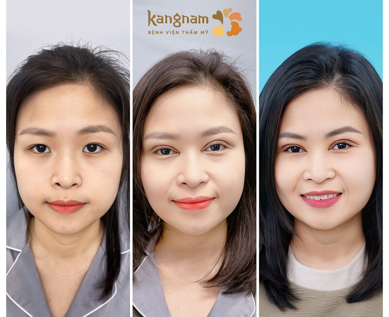 Mí mắt cân đối, hài hòa với khuôn mặt