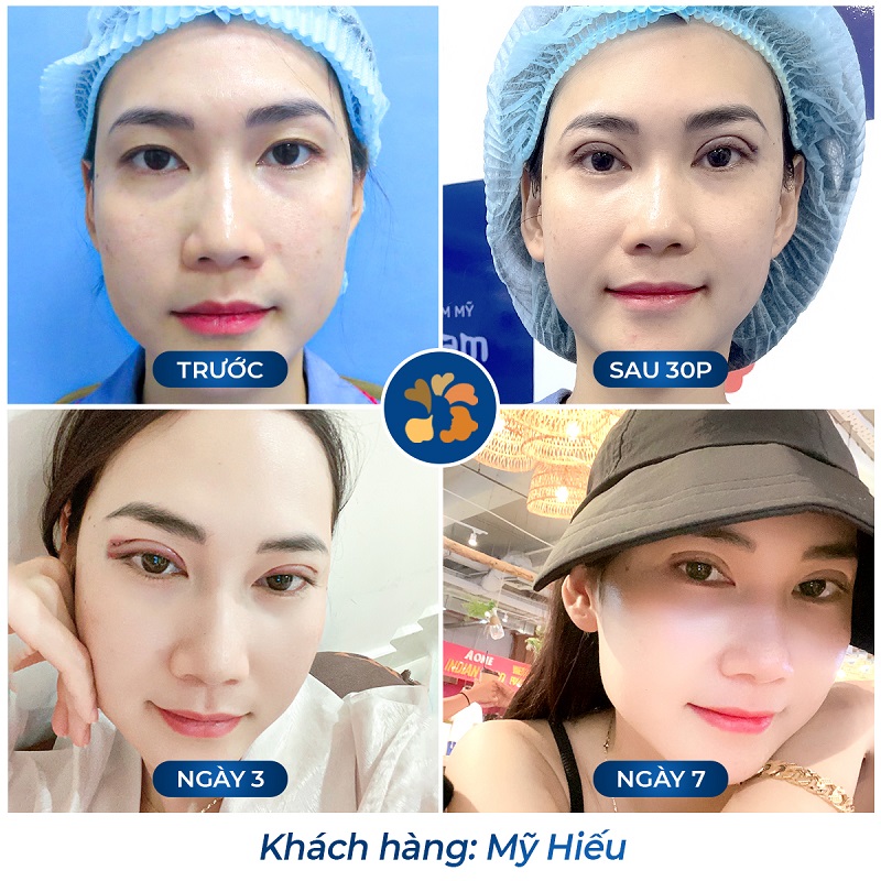 Một số trường hợp 3 ngày sau cắt mí vẫn sưng bầm tím