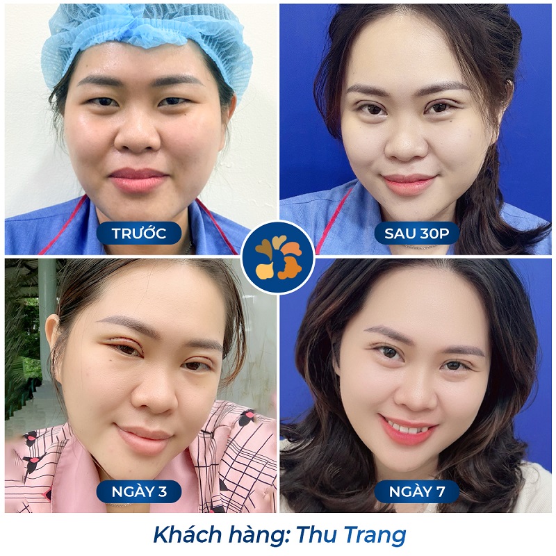 Nếp mí phục hồi nhanh chóng, vào form sau 7 ngày