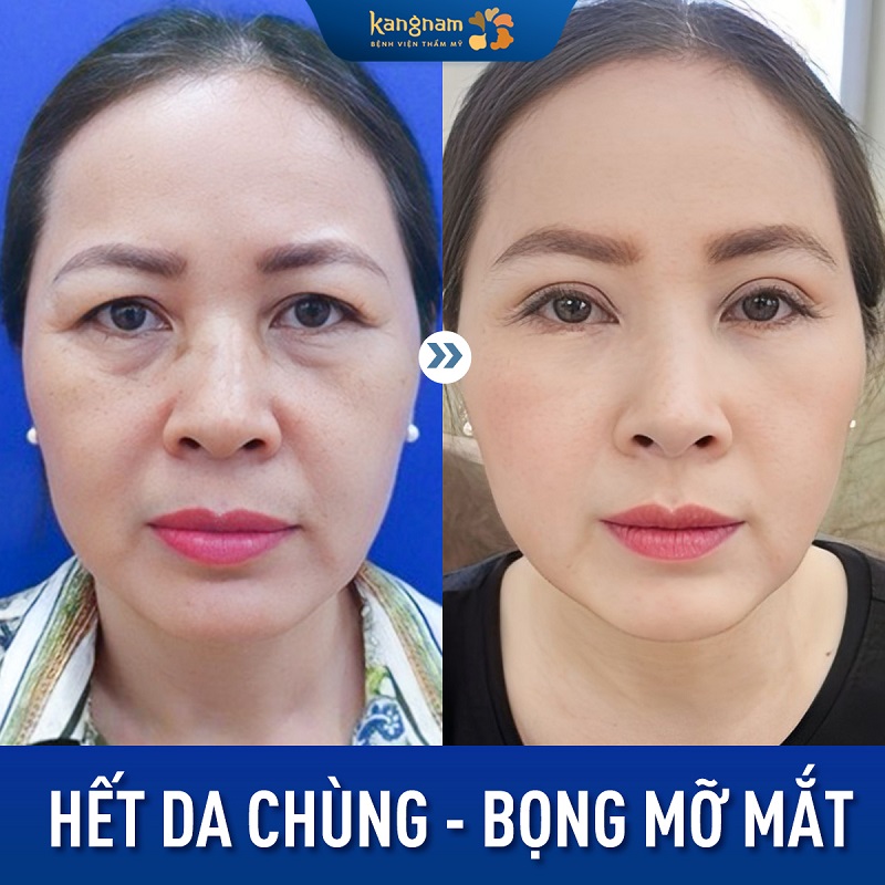 Cắt da thừa đúng cách sẽ không để lại sẹo