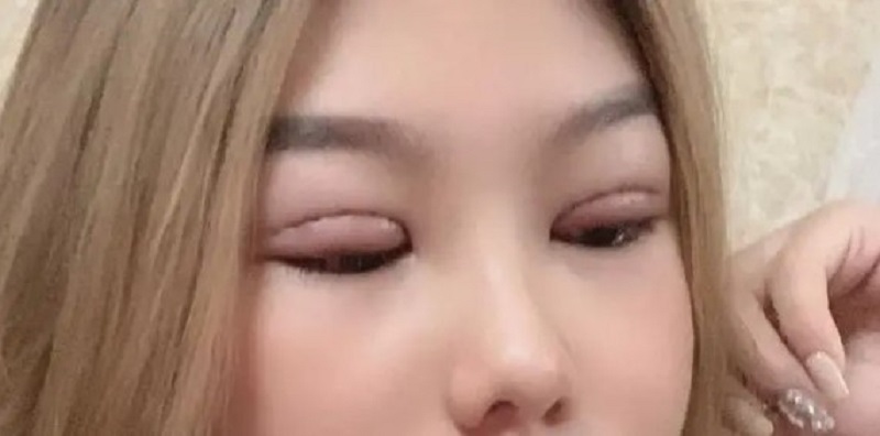 Cắt mí 2 tháng vẫn sưng là dấu hiệu cảnh báo nguy cơ biến chứng