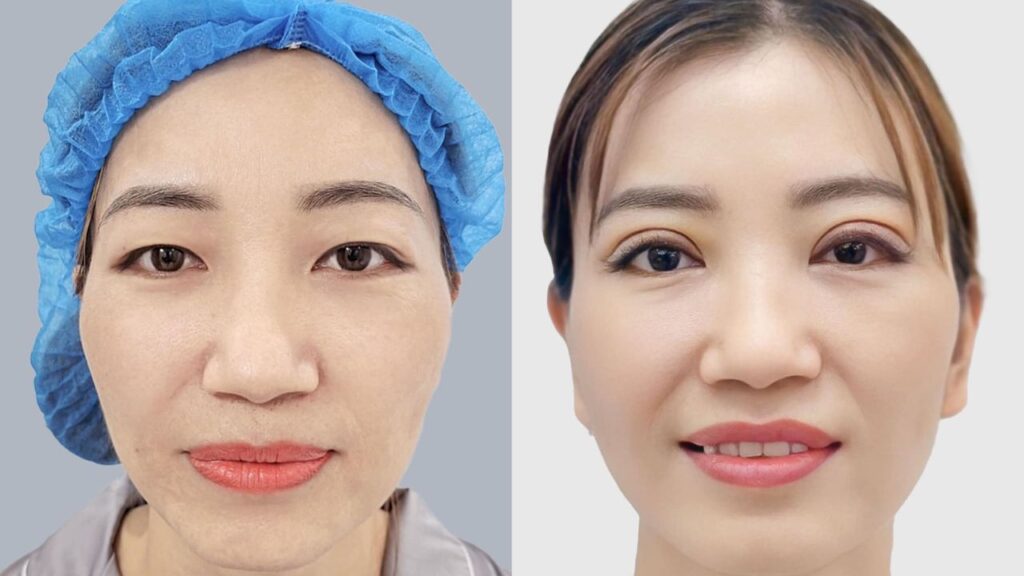 Cắt mí sau bao lâu thì đẹp tự nhiên? Lộ trình hồi phục theo từng giai đoạn