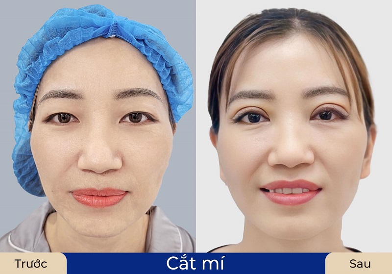 Mí mắt của khách hàng đẹp tự nhiên sau 1 tháng