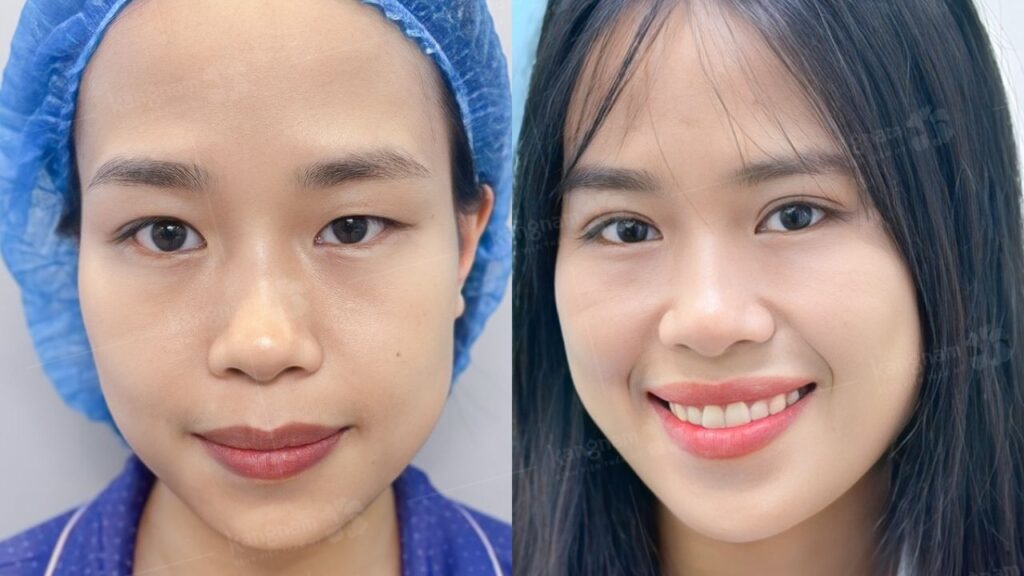 Cắt mí mắt bao lâu thì lành? Thời gian hồi phục và cách chăm sóc đúng