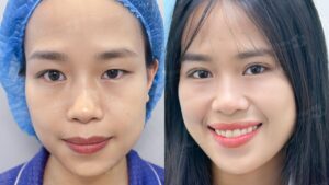 Cắt mí mắt bao lâu thì lành? Thời gian hồi phục và cách chăm sóc đúng