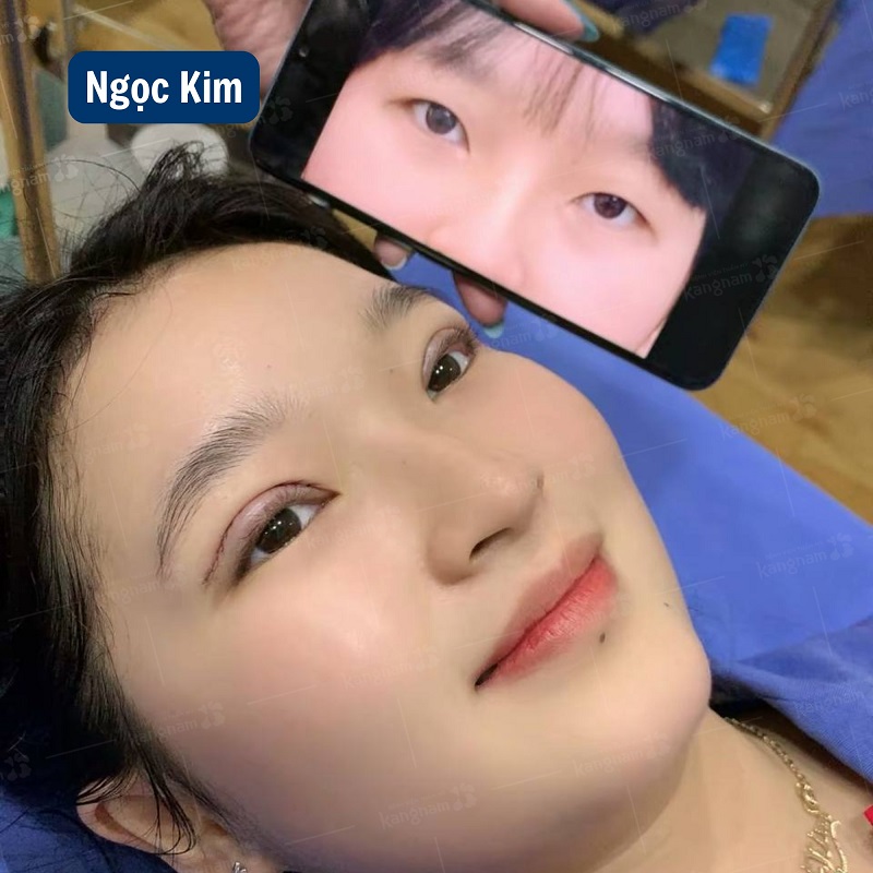 Mí mắt bị tác động nên sẽ có phản ứng sưng bầm