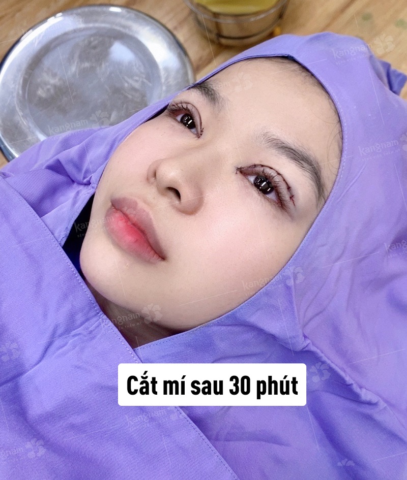 Sau khi thuốc tê hết tác dụng vùng mí sẽ hơi sưng đau