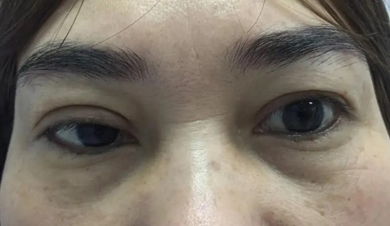 Mí mắt không nhắm được sau khi cắt mí