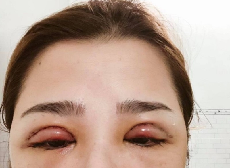 Việc cắt quá nhiều da dư, mỡ thừa khiến mí mắt không nhắm được, sưng tấy kéo dài