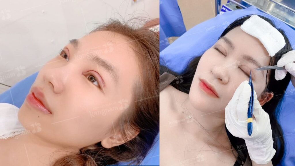 Cắt mí mắt bao lâu thì cắt chỉ? Thời gian cắt chỉ an toàn và lưu ý quan trọng