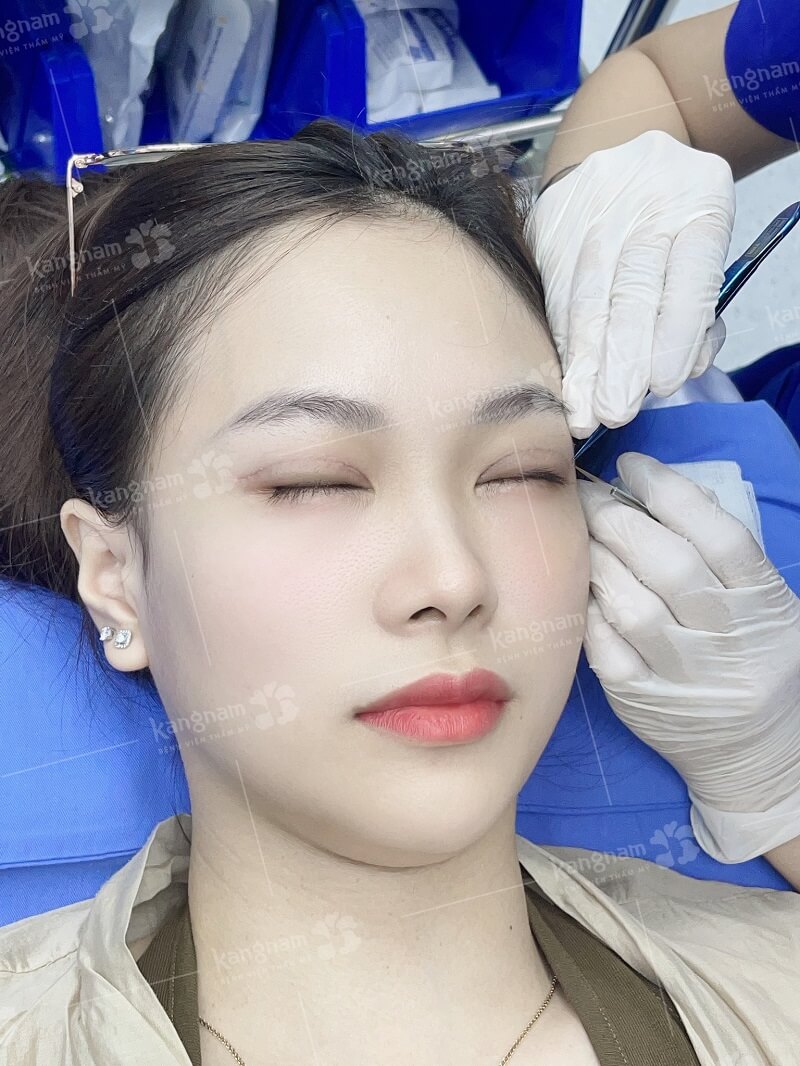 Mí mắt lành và ổn định khách hàng sẽ được cắt chỉ