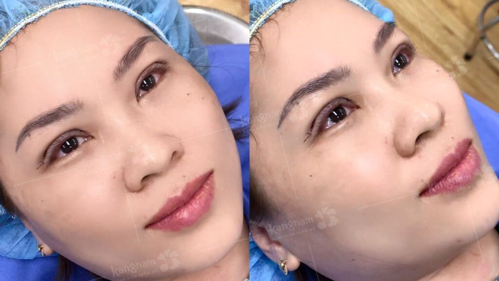 Cắt mí mắt bị bầm tím bao lâu thì khỏi? cách chăm sóc đúng cách