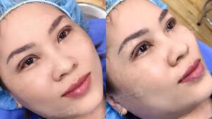 Cắt mí mắt bị bầm tím bao lâu thì khỏi