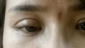 Cắt mí mắt bị sâu do đâu