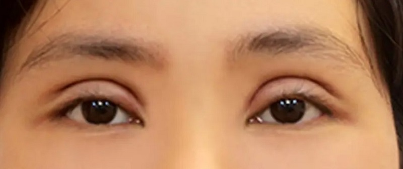 Kỹ thuật cắt mí của bác sĩ không đúng làm mí mắt bị sâu