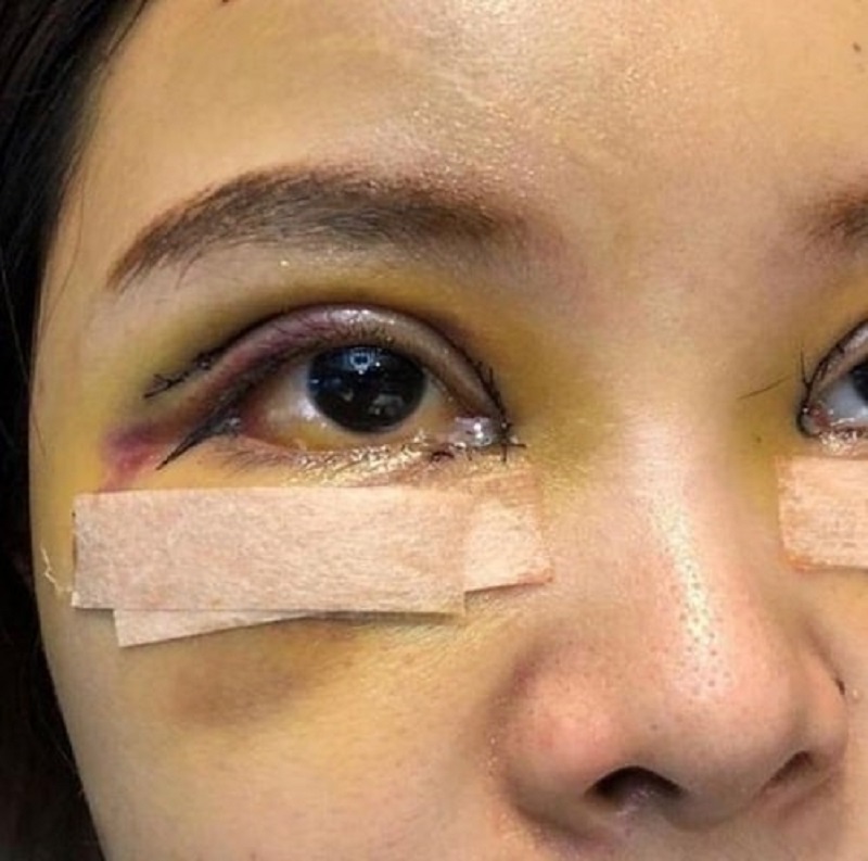 Cần phải can thiệp điều trị mí mắt sau cắt bị sâu