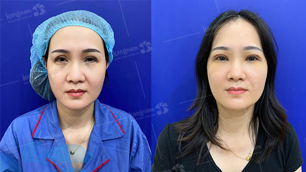 Khách hàng được chỉnh sửa lại đôi mắt cân đối