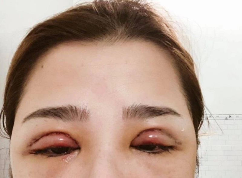 Nếp mí quá to do kỹ thuật thực hiện không chính xác