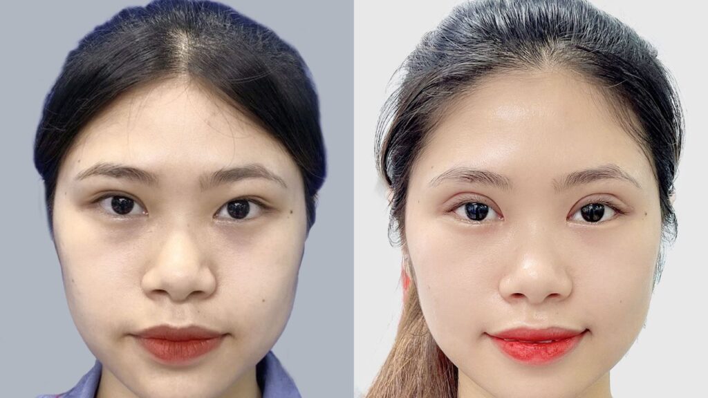 Cắt mí mấy tháng thì đẹp tự nhiên? Lộ trình hồi phục theo từng giai đoạn