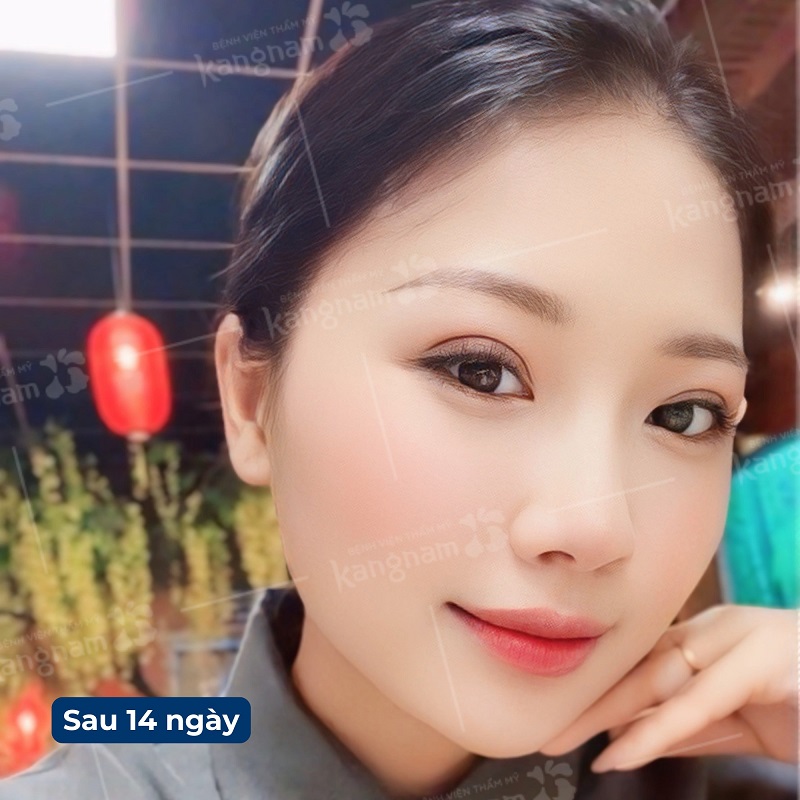 Sau khoảng 2 tuần mí mắt đã ổn định hơn
