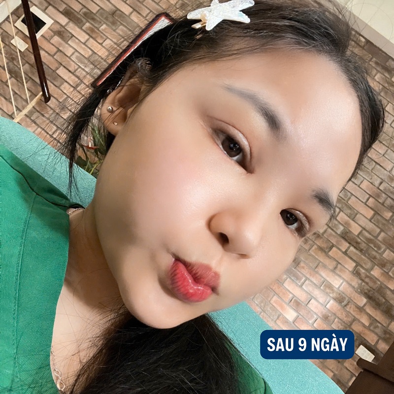 Ăn uống khoa học sẽ giúp mí mắt nhanh lành