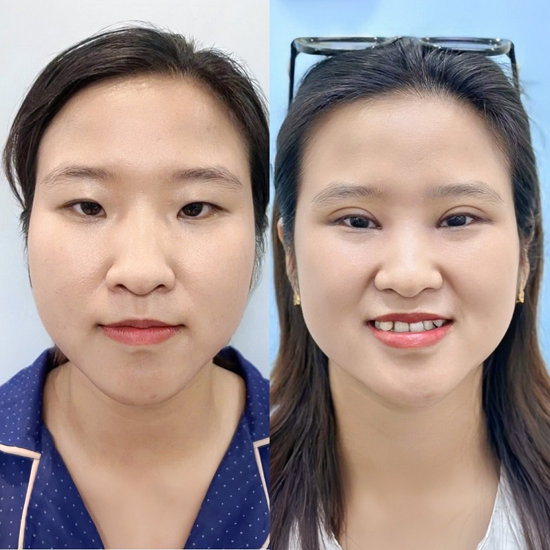 Cắt mí giúp gương mặt tươi trẻ, tự tin hơn