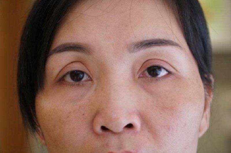 Can thiệp cắt mí không đúng kỹ thuật, quá to, mí mắt không đều