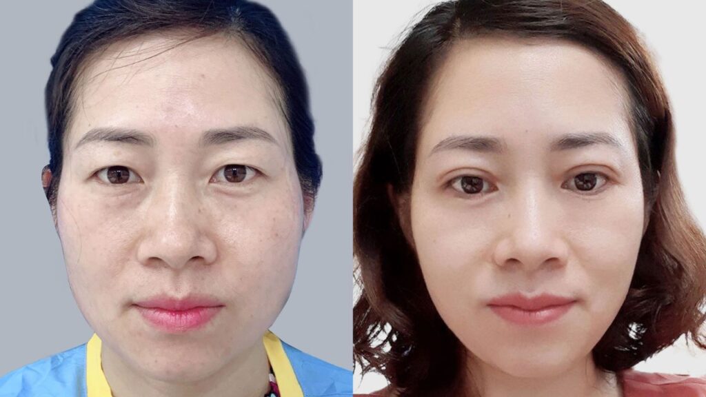 Cắt mí sau 6 tháng đã ổn định chưa? Dấu hiệu bình thường & bất thường