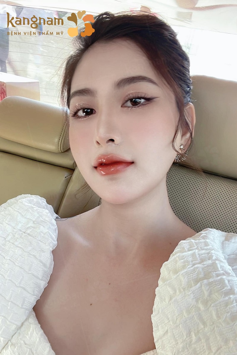 Cắt mí sau 6 tháng nếp mí đã đẹp và form, cân đối